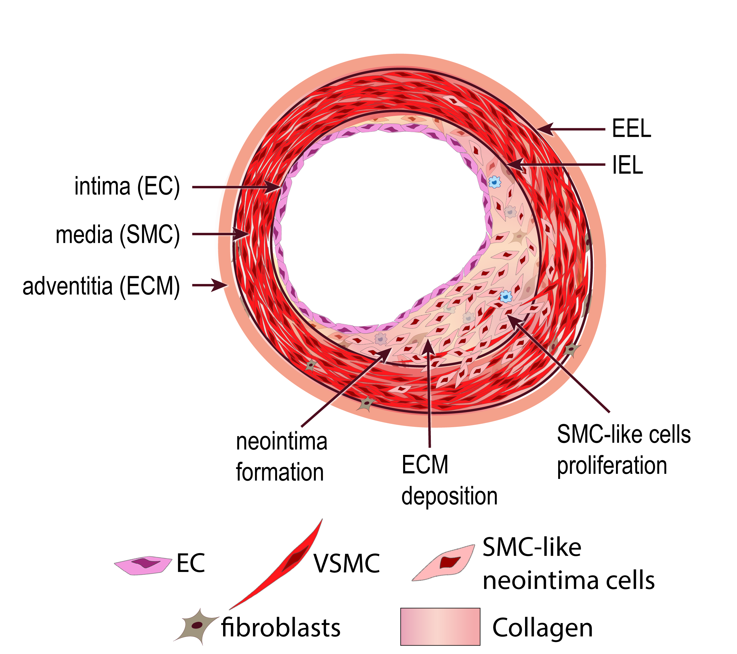 Intimal Hyperplasia And Restenosis Service De Chirurgie Vasculaire CHUV