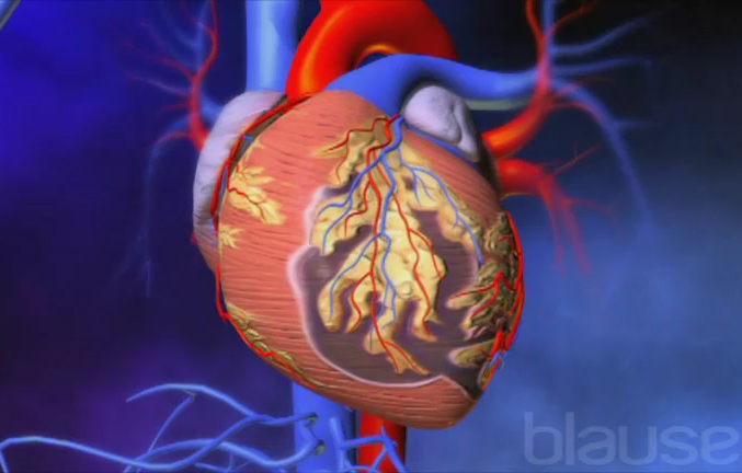 En cas d’infarctus du myocarde, le temps c’est du muscle! - Service de