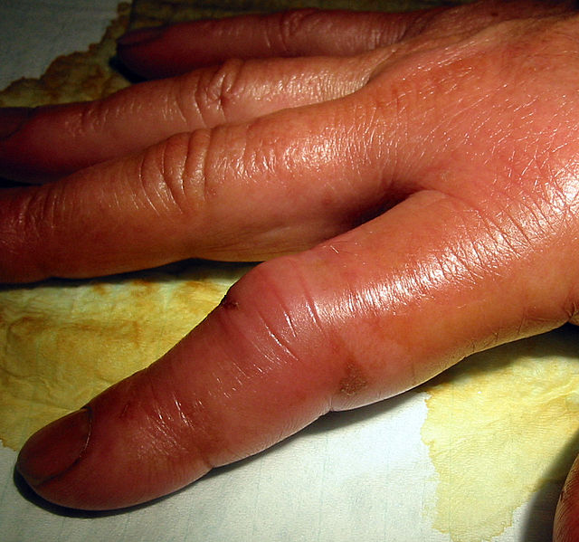 Traumatisme des doigts et traumatisme du pouce, Pathologies traumatiques  du doigt